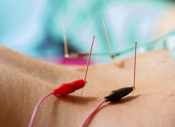 Electroacupuncture